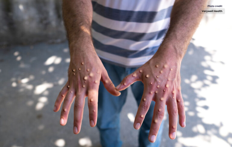 پاکستان میں مونکی پوکس کے کیسز پائے گئے،خصوصی ہدایات جاری