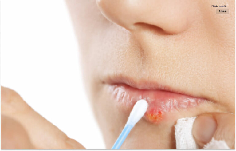 سردی کے زخم پر قابو پانا مؤثر علاج اور گھریلو ٹوٹکے